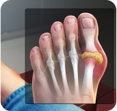 Gout